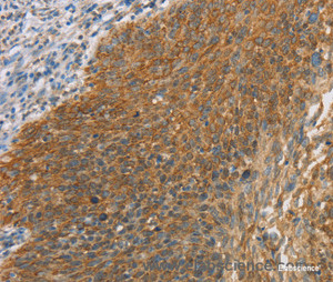Immunohistochemistry of paraffin-embedded Human cervical cancer tissue using ERK 3 Polyclonal Antibody at dilution 1:40