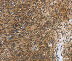 Immunohistochemistry of paraffin-embedded Human cervical cancer tissue using FOXB1 Polyclonal Antibody at dilution 1:30
