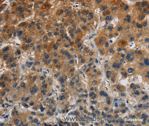 Immunohistochemistry of paraffin-embedded Human liver cancer tissue using Claudin 8 Polyclonal Antibody at dilution 1:50