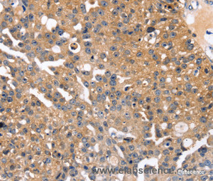 Immunohistochemistry of paraffin-embedded Human breast cancer tissue using SLC2A2 Polyclonal Antibody at dilution 1:35