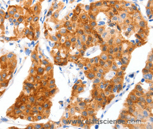 Immunohistochemistry of paraffin-embedded Human lung cancer tissue using GLUT-4 Polyclonal Antibody at dilution 1:70