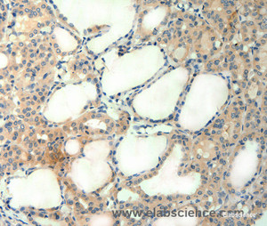 Immunohistochemistry of paraffin-embedded Human thyroid cancer tissue using AGRN Polyclonal Antibody at dilution of 1:50