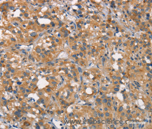 Immunohistochemistry of paraffin-embedded Human thyroid cancer tissue using CEACAM6 Polyclonal Antibody at dilution 1:50