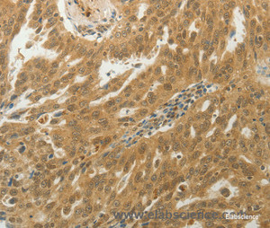 Immunohistochemistry of paraffin-embedded Human ovarian cancer tissue using MYSM1 Polyclonal Antibody at dilution 1:50