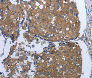 Immunohistochemistry of paraffin-embedded Human breast cancer tissue using PDIA2 Polyclonal Antibody at dilution 1:50