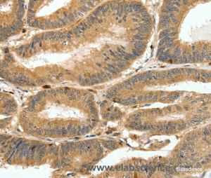 Immunohistochemistry of paraffin-embedded Human colon cancer tissue using S100A4 Polyclonal Antibody at dilution 1:80