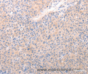 Immunohistochemistry of paraffin-embedded Human liver cancer tissue using ACO1 Polyclonal Antibody at dilution 1:50