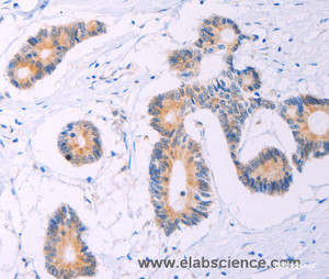 Immunohistochemistry of paraffin-embedded Human colon cancer tissue using ADCY5 Polyclonal Antibody at dilution 1:30