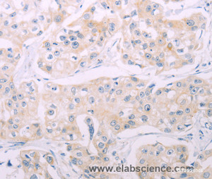 Immunohistochemistry of paraffin-embedded Human breast cancer tissue using ADCY7 Polyclonal Antibody at dilution 1:60