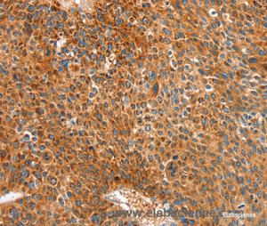 Immunohistochemistry of paraffin-embedded Human liver cancer tissue using ALDH1A2 Polyclonal Antibody at dilution 1:30