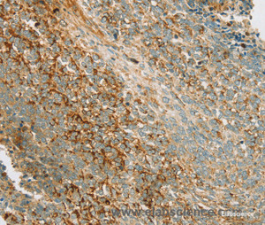 Immunohistochemistry of paraffin-embedded Human ovarian cancer tissue using AMPK alpha1 Polyclonal Antibody at dilution 1:70