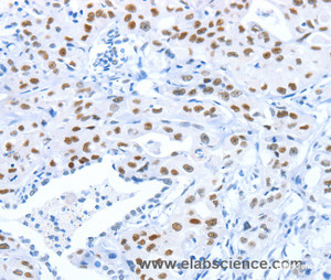 Immunohistochemistry of paraffin-embedded Human lung cancer tissue using ARID1A Polyclonal Antibody at dilution 1:80