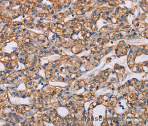 Immunohistochemistry of paraffin-embedded Human prostate cancer tissue using ARAP1 Polyclonal Antibody at dilution 1:40