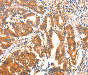 Immunohistochemistry of paraffin-embedded Human gasrtic cancer tissue using AK5 Polyclonal Antibody at dilution 1:60