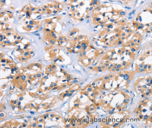 Immunohistochemistry of paraffin-embedded Human thyroid cancer tissue using APOL6 Polyclonal Antibody at dilution 1:50