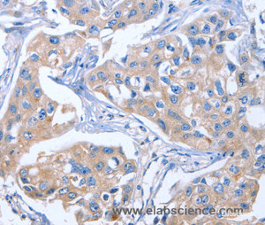 Immunohistochemistry of paraffin-embedded Human breast cancer tissue using IBSP Polyclonal Antibody at dilution of 1:50