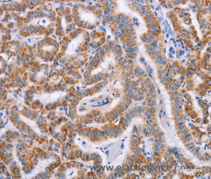 Immunohistochemistry of paraffin-embedded Human thyroid cancer tissue using BST1 Polyclonal Antibody at dilution 1:50