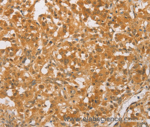 Immunohistochemistry of paraffin-embedded Human thyroid cancer tissue using CEBP beta Polyclonal Antibody at dilution 1:60