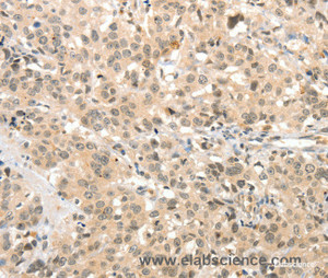 Immunohistochemistry of paraffin-embedded Human esophagus cancer tissue using TSPYL2 Polyclonal Antibody at dilution 1:30