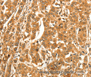 Immunohistochemistry of paraffin-embedded Human breast cancer tissue using DIRAS1 Polyclonal Antibody at dilution 1:52