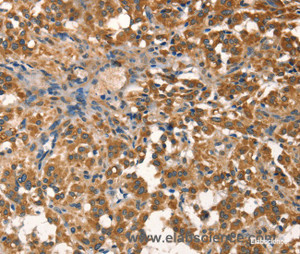 Immunohistochemistry of paraffin-embedded Human thyroid cancer tissue using AGO1 Polyclonal Antibody at dilution 1:40
