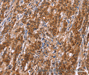 Immunohistochemistry of paraffin-embedded Human gasrtic cancer tissue using TDP2 Polyclonal Antibody at dilution 1:40