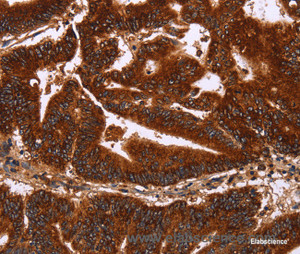 Immunohistochemistry of paraffin-embedded Human colon cancer tissue using GCKR Polyclonal Antibody at dilution 1:50