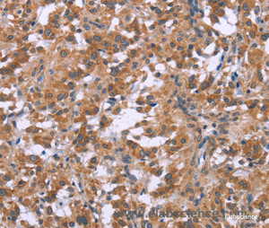 Immunohistochemistry of paraffin-embedded Human thyroid cancer tissue using GNPAT Polyclonal Antibody at dilution 1:40
