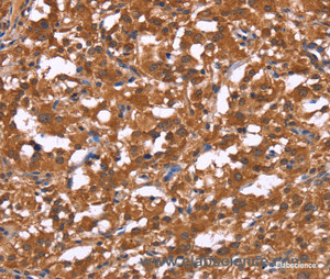 Immunohistochemistry of paraffin-embedded Human thyroid cancer tissue using HLTF Polyclonal Antibody at dilution 1:30