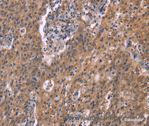 Immunohistochemistry of paraffin-embedded Human liver cancer tissue using HSD11B2 Polyclonal Antibody at dilution 1:35