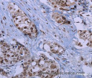 Immunohistochemistry of paraffin-embedded Human breast cancer tissue using ID3 Polyclonal Antibody at dilution 1:40