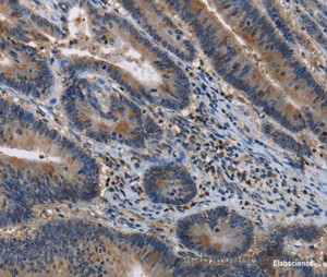 Immunohistochemistry of paraffin-embedded Human colon cancer tissue using ITPR2 Polyclonal Antibody at dilution 1:40