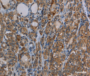 Immunohistochemistry of paraffin-embedded Human thyroid cancer tissue using MYO7A Polyclonal Antibody at dilution 1:30