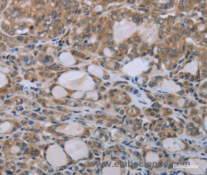 Immunohistochemistry of paraffin-embedded Human thyroid cancer tissue using NAIP Polyclonal Antibody at dilution 1:30