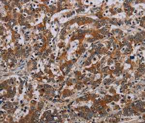 Immunohistochemistry of paraffin-embedded Human liver cancer tissue using NLRP9 Polyclonal Antibody at dilution 1:40