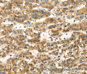Immunohistochemistry of paraffin-embedded Human ovarian cancer tissue using PAPPA Polyclonal Antibody at dilution of 1:50