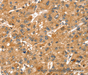 Immunohistochemistry of paraffin-embedded Human liver cancer tissue using SPTAN1 Polyclonal Antibody at dilution 1:40