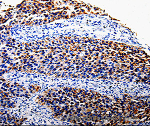 Immunohistochemistry of paraffin-embedded Human renal cancer tissue using COX10 Polyclonal Antibody at dilution 1:100