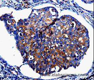 Immunohistochemistry of paraffin-embedded Human breast cancer tissue using IL10RB Polyclonal Antibody at dilution 1:60