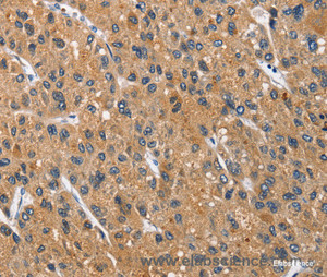 Immunohistochemistry of paraffin-embedded Human liver cancer tissue using CEACAM3 Polyclonal Antibody at dilution 1:70