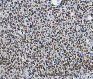 Immunohistochemistry of paraffin-embedded Human lung cancer tissue using CMTM2 Polyclonal Antibody at dilution 1:60