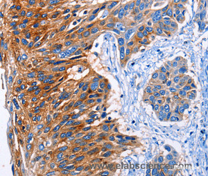 Immunohistochemistry of paraffin-embedded Human esophagus cancer tissue using CLEC2B Polyclonal Antibody at dilution 1:50