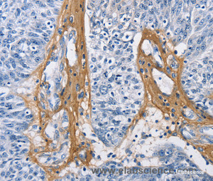 Immunohistochemistry of paraffin-embedded Human ovarian cancer tissue using COL3A1 Polyclonal Antibody at dilution 1:60