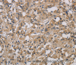 Immunohistochemistry of paraffin-embedded Human thyroid cancer tissue using DCN Polyclonal Antibody at dilution 1:30