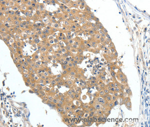 Immunohistochemistry of paraffin-embedded Human breast cancer tissue using FSHR Polyclonal Antibody at dilution 1:70