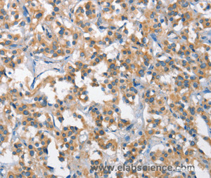 Immunohistochemistry of paraffin-embedded Human thyroid cancer tissue using SCARB1 Polyclonal Antibody at dilution 1:65