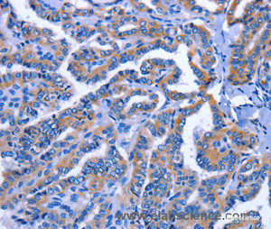 Immunohistochemistry of paraffin-embedded Human thyroid cancer tissue using IGSF10 Polyclonal Antibody at dilution 1:60