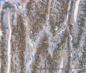 Immunohistochemistry of paraffin-embedded Human colon cancer tissue using GNRH1 Polyclonal Antibody at dilution 1:65
