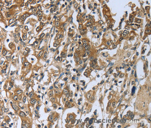 Immunohistochemistry of paraffin-embedded Human gasrtic cancer tissue using PRL Polyclonal Antibody at dilution 1:50