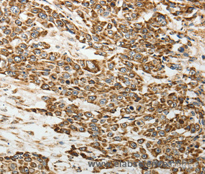 Immunohistochemistry of paraffin-embedded Human esophagus cancer tissue using E-Selectin Polyclonal Antibody at dilution of 1:30